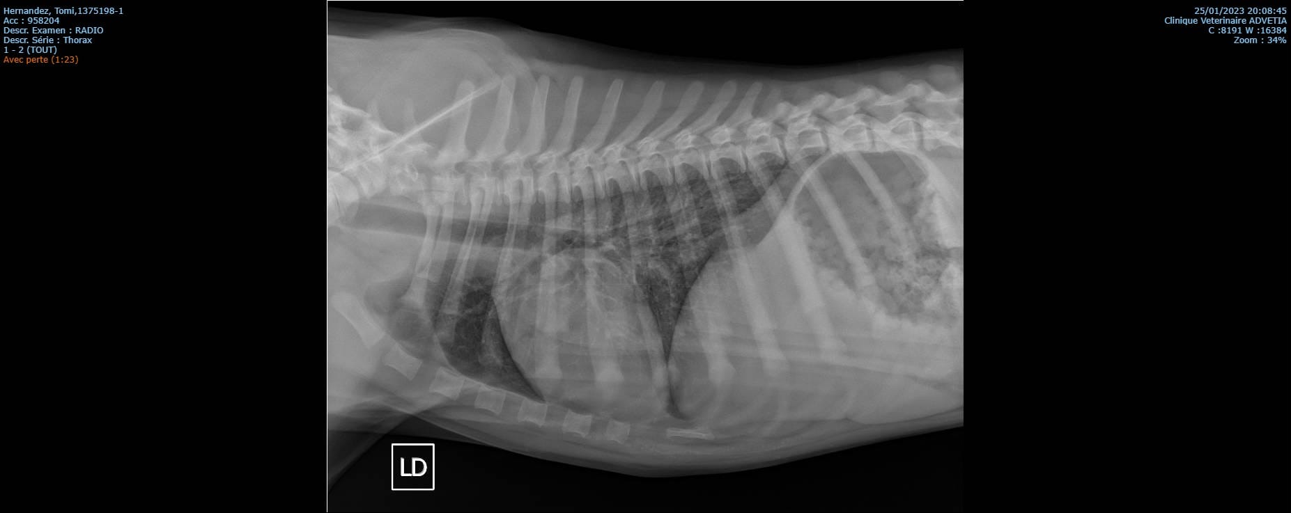 Ostéodystrophie hypertrohique